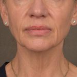 Neck Lift Before & After Patient #3662