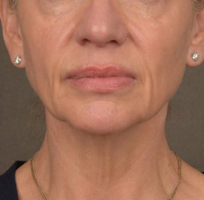 Neck Lift Before & After Patient #3662