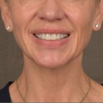 Neck Lift Before & After Patient #3662