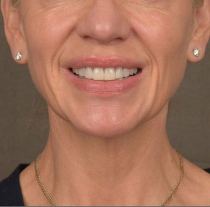 Neck Lift Before & After Patient #3662