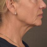 Neck Lift Before & After Patient #3662