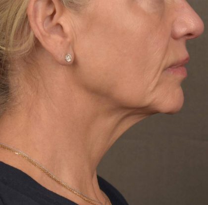 Neck Lift Before & After Patient #3662
