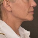 Neck Lift Before & After Patient #3662