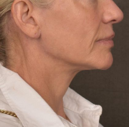 Neck Lift Before & After Patient #3662