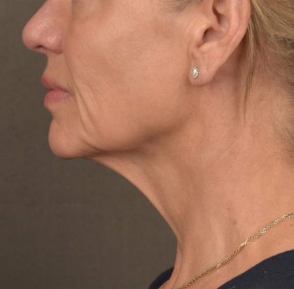 Neck Lift Before & After Patient #3662