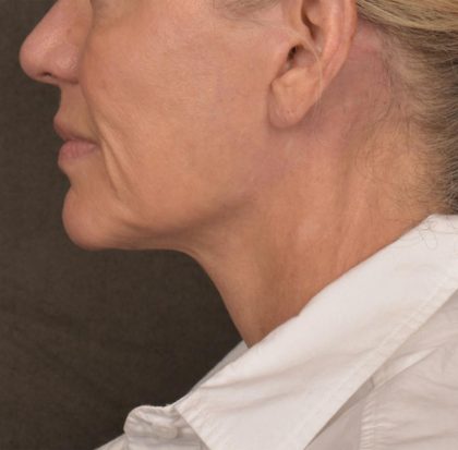 Neck Lift Before & After Patient #3662