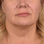 Neck Lift Before & After Patient #3661