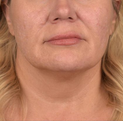 Neck Lift Before & After Patient #3661