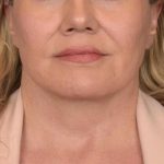 Neck Lift Before & After Patient #3661