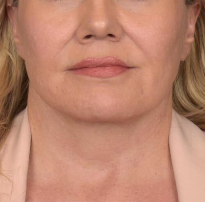 Neck Lift Before & After Patient #3661