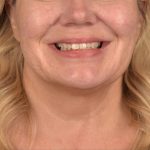 Neck Lift Before & After Patient #3661