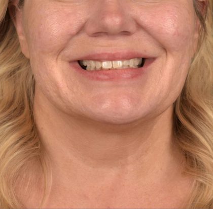 Neck Lift Before & After Patient #3661