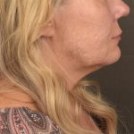 Neck Lift Before & After Patient #3661