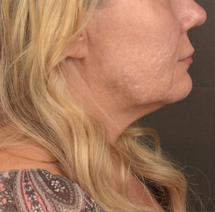 Neck Lift Before & After Patient #3661