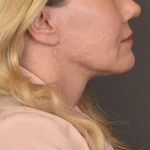 Neck Lift Before & After Patient #3661