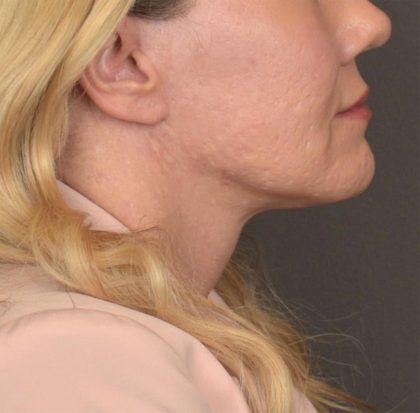 Neck Lift Before & After Patient #3661