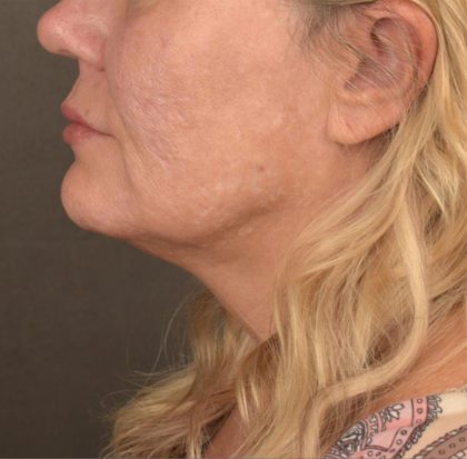 Neck Lift Before & After Patient #3661