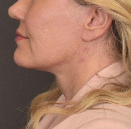 Neck Lift Before & After Patient #3661