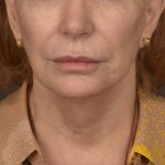 Neck Lift Before & After Patient #3667