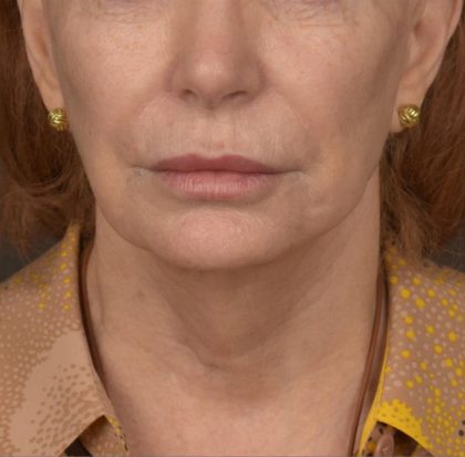 Neck Lift Before & After Patient #3667