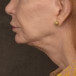 Neck Lift Before & After Patient #3667