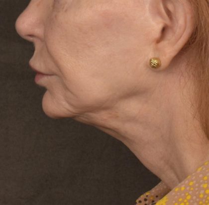 Neck Lift Before & After Patient #3667