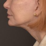 Neck Lift Before & After Patient #3667