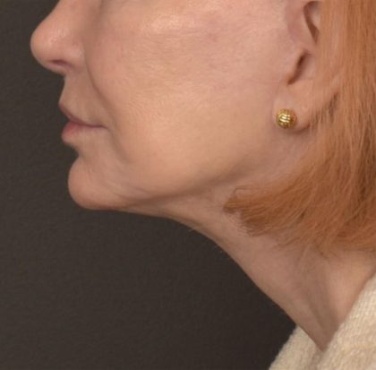 Neck Lift Before & After Patient #3667