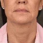 Neck Lift Before & After Patient #3660