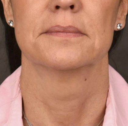 Neck Lift Before & After Patient #3660