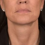 Neck Lift Before & After Patient #3660