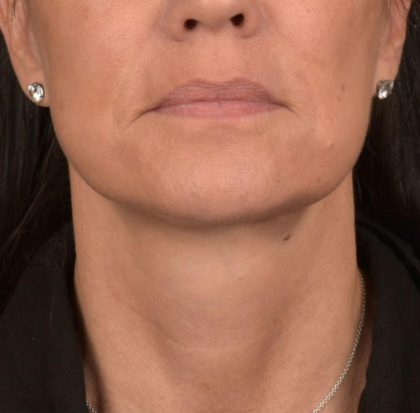 Neck Lift Before & After Patient #3660