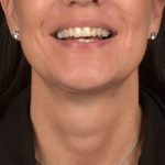 Neck Lift Before & After Patient #3660