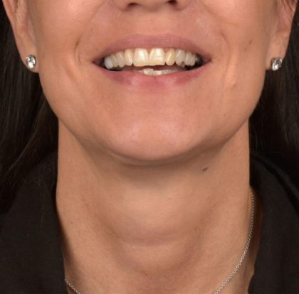 Neck Lift Before & After Patient #3660
