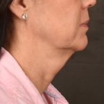 Neck Lift Before & After Patient #3660