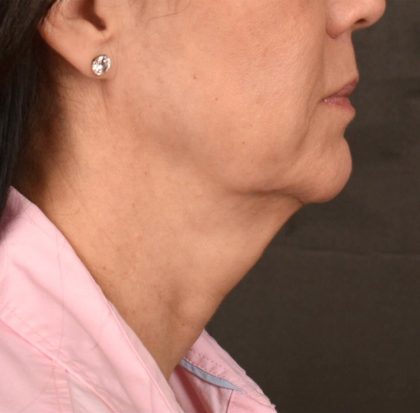 Neck Lift Before & After Patient #3660