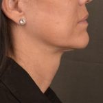Neck Lift Before & After Patient #3660