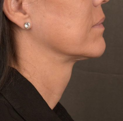 Neck Lift Before & After Patient #3660