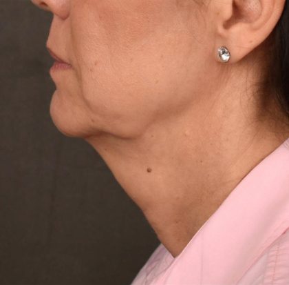 Neck Lift Before & After Patient #3660