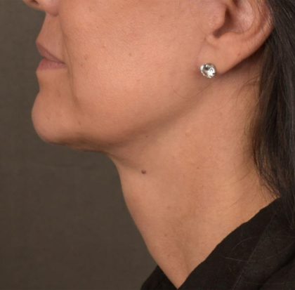 Neck Lift Before & After Patient #3660