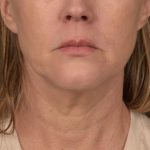 Neck Lift Before & After Patient #3654