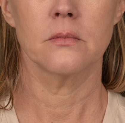 Neck Lift Before & After Patient #3654