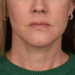 Neck Lift Before & After Patient #3654