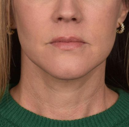 Neck Lift Before & After Patient #3654