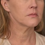 Neck Lift Before & After Patient #3654