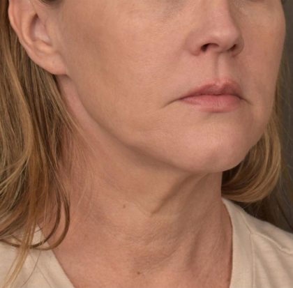 Neck Lift Before & After Patient #3654