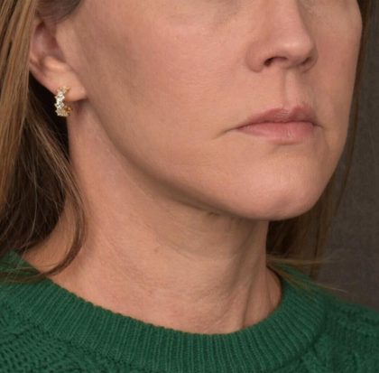 Neck Lift Before & After Patient #3654