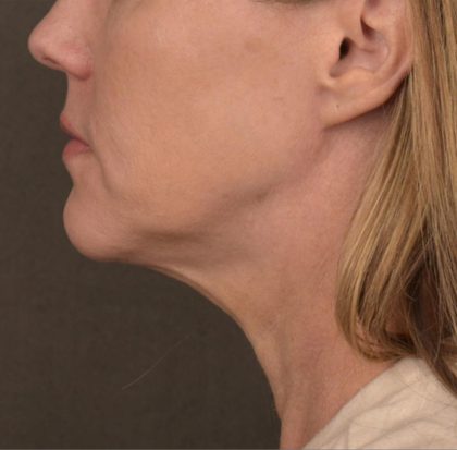 Neck Lift Before & After Patient #3654