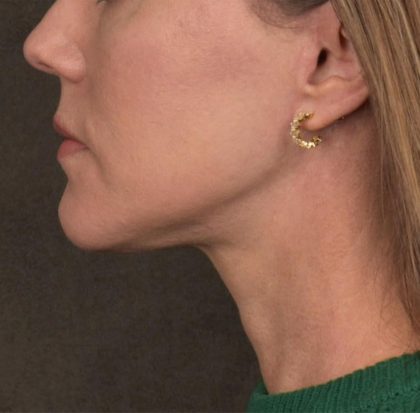 Neck Lift Before & After Patient #3654