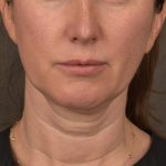 Neck Lift Before & After Patient #3663
